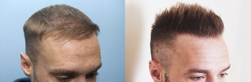 stop hair loss and regrow new hair with the maliniak method